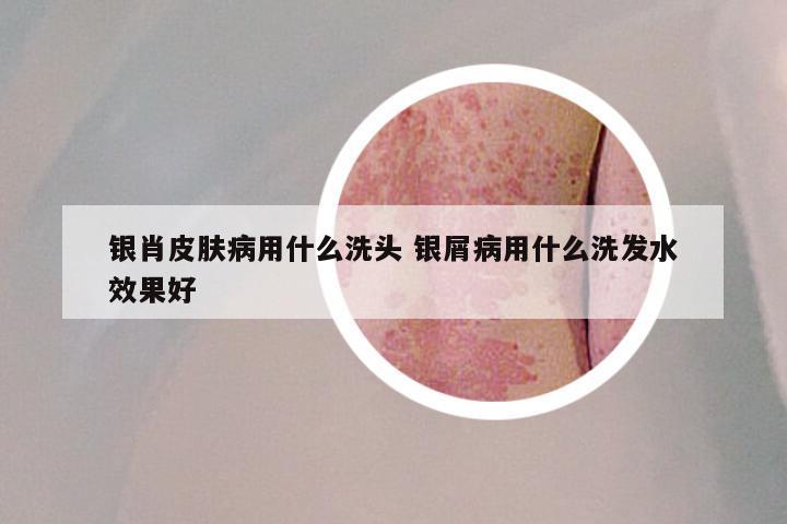 银肖皮肤病用什么洗头 银屑病用什么洗发水效果好