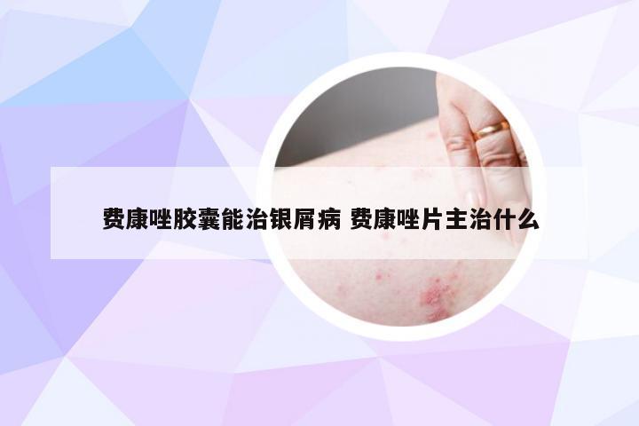 费康唑胶囊能治银屑病 费康唑片主治什么