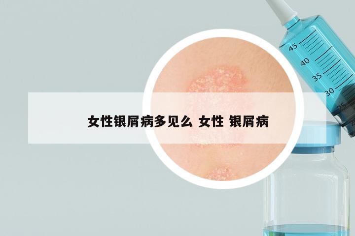 女性银屑病多见么 女性 银屑病