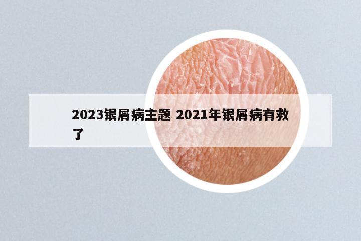 2023银屑病主题 2021年银屑病有救了