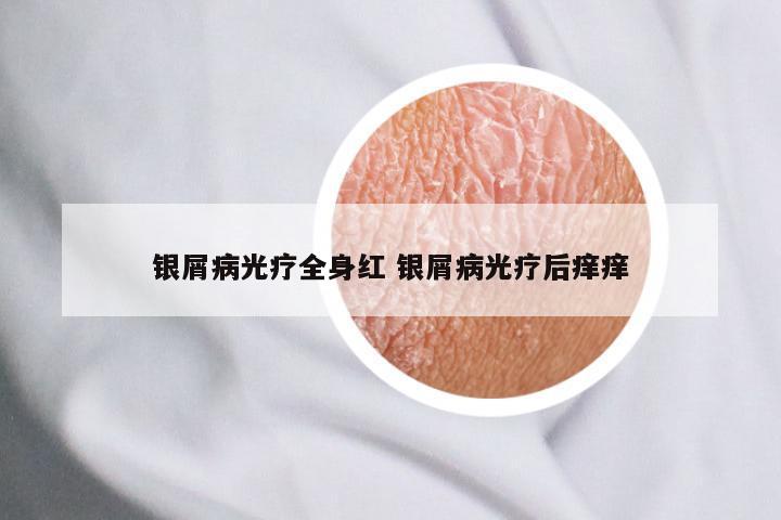 银屑病光疗全身红 银屑病光疗后痒痒