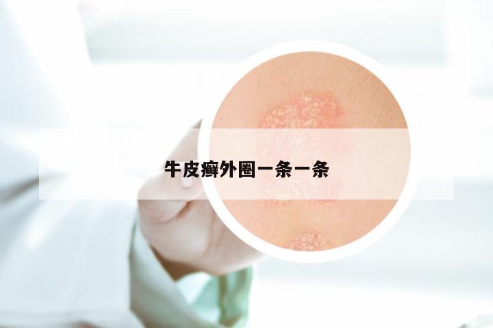 牛皮癣外圈一条一条