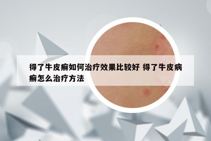 得了牛皮癣如何治疗效果比较好 得了牛皮病癣怎么治疗方法