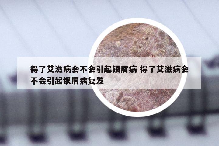 得了艾滋病会不会引起银屑病 得了艾滋病会不会引起银屑病复发
