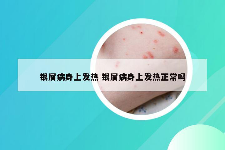 银屑病身上发热 银屑病身上发热正常吗