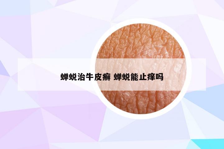 蝉蜕治牛皮癣 蝉蜕能止痒吗