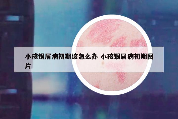 小孩银屑病初期该怎么办 小孩银屑病初期图片
