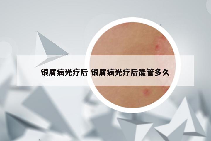 银屑病光疗后 银屑病光疗后能管多久