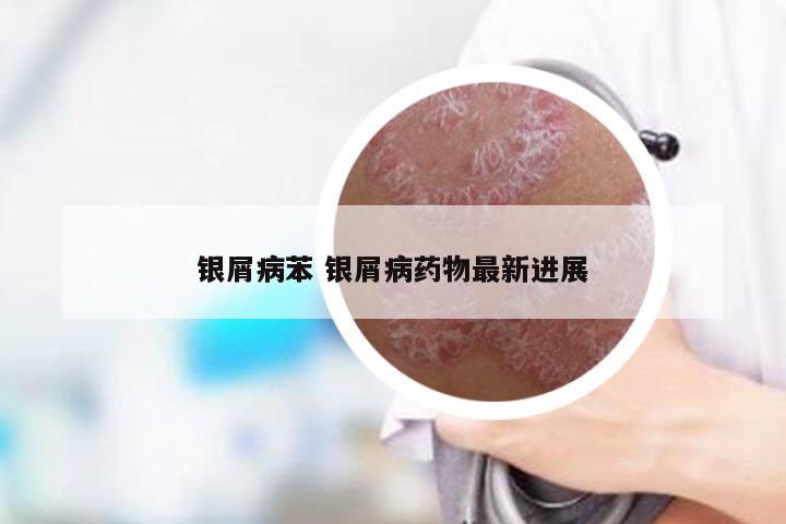 银屑病苯 银屑病药物最新进展