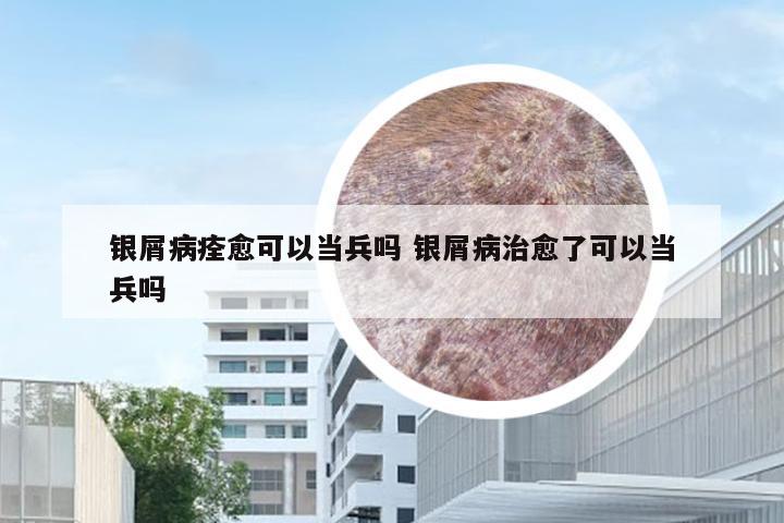 银屑病痊愈可以当兵吗 银屑病治愈了可以当兵吗