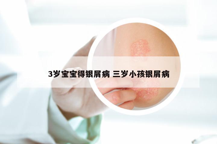 3岁宝宝得银屑病 三岁小孩银屑病
