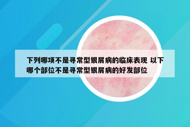 下列哪项不是寻常型银屑病的临床表现 以下哪个部位不是寻常型银屑病的好发部位