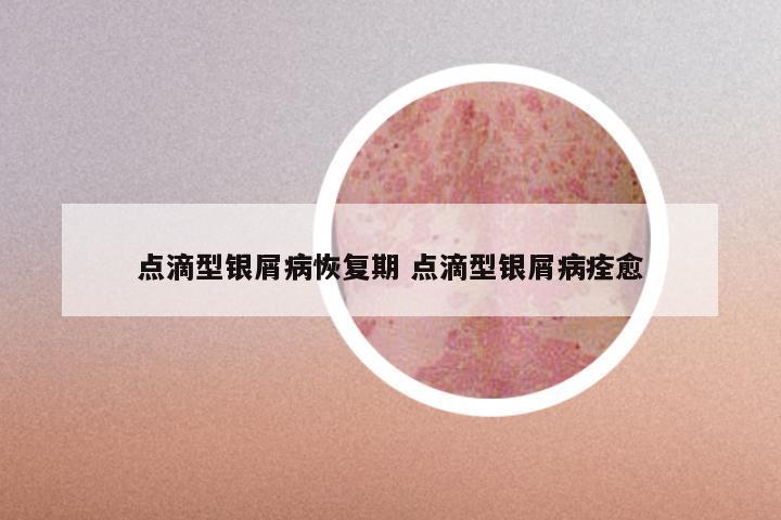 点滴型银屑病恢复期 点滴型银屑病痊愈