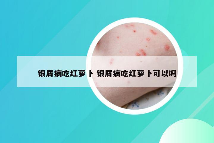 银屑病吃红萝卜 银屑病吃红萝卜可以吗