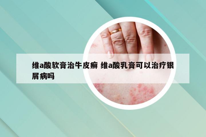 维a酸软膏治牛皮癣 维a酸乳膏可以治疗银屑病吗