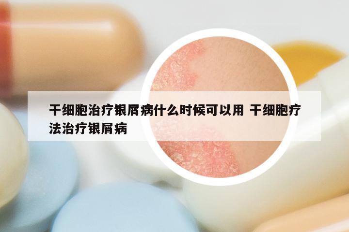 干细胞治疗银屑病什么时候可以用 干细胞疗法治疗银屑病