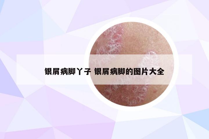 银屑病脚丫子 银屑病脚的图片大全