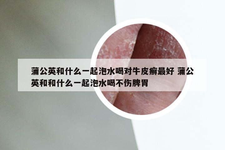 蒲公英和什么一起泡水喝对牛皮癣最好 蒲公英和和什么一起泡水喝不伤脾胃