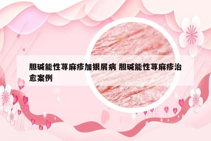 胆碱能性荨麻疹加银屑病 胆碱能性荨麻疹治愈案例