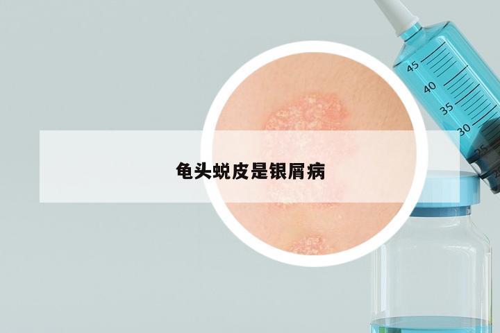 龟头蜕皮是银屑病