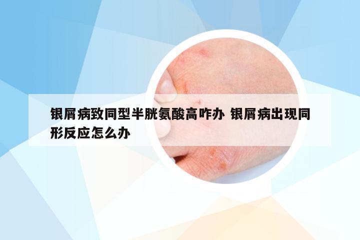 银屑病致同型半胱氨酸高咋办 银屑病出现同形反应怎么办