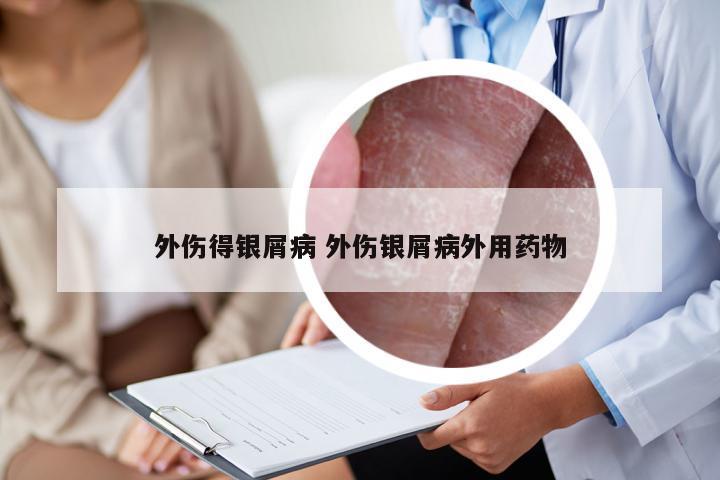 外伤得银屑病 外伤银屑病外用药物