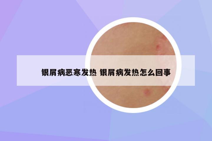 银屑病恶寒发热 银屑病发热怎么回事