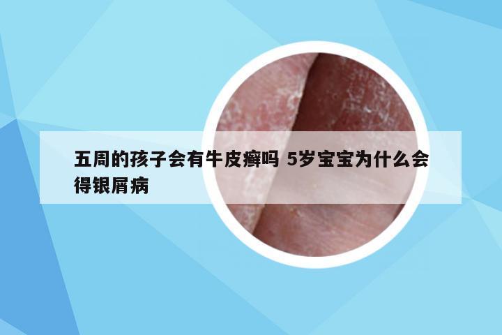 五周的孩子会有牛皮癣吗 5岁宝宝为什么会得银屑病