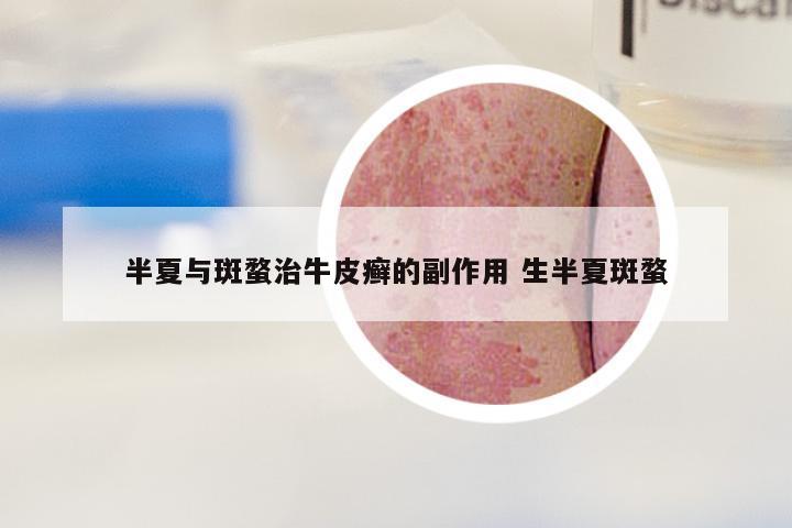 半夏与斑蝥治牛皮癣的副作用 生半夏斑蝥