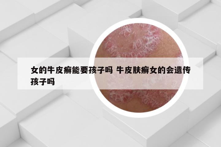 女的牛皮癣能要孩子吗 牛皮肤癣女的会遗传孩子吗