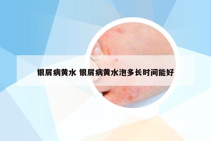 银屑病黄水 银屑病黄水泡多长时间能好