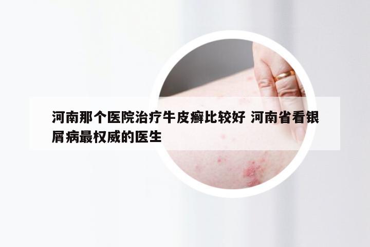 河南那个医院治疗牛皮癣比较好 河南省看银屑病最权威的医生