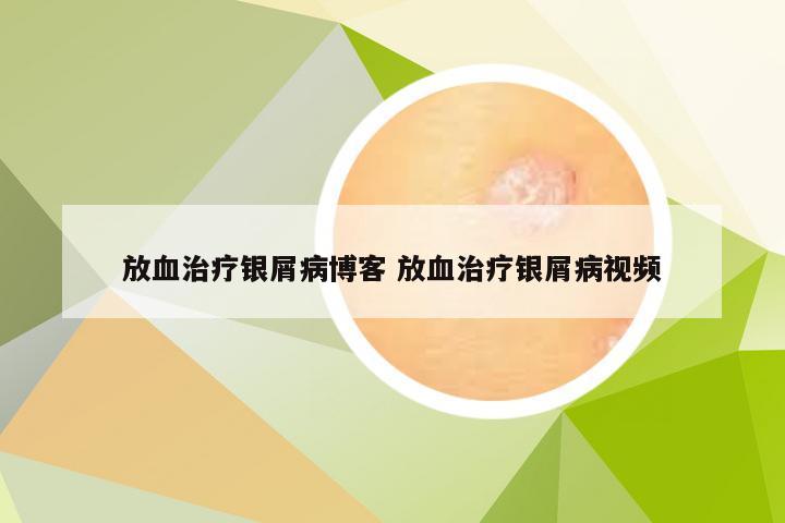 放血治疗银屑病博客 放血治疗银屑病视频