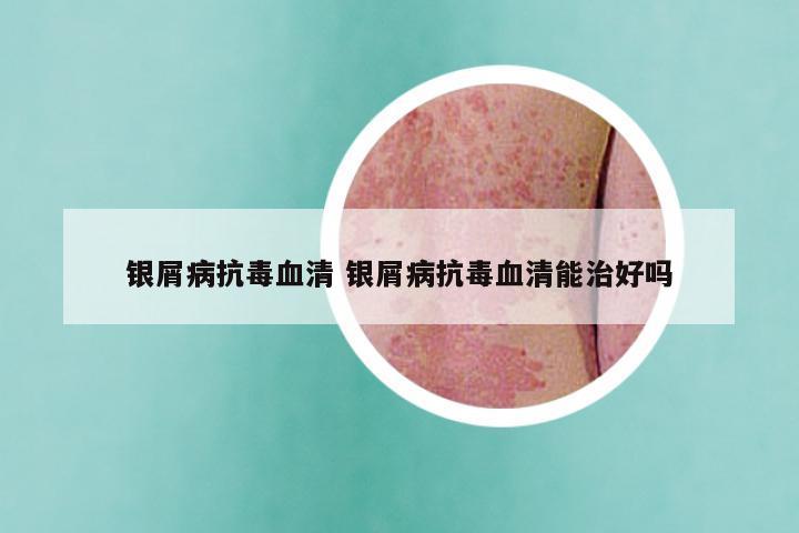 银屑病抗毒血清 银屑病抗毒血清能治好吗