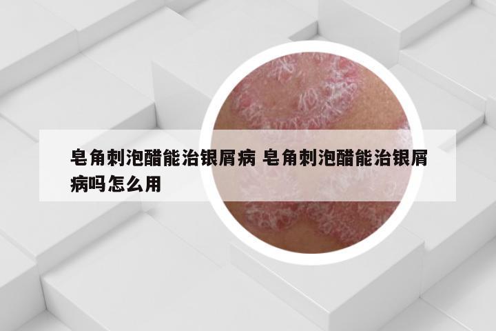 皂角刺泡醋能治银屑病 皂角刺泡醋能治银屑病吗怎么用