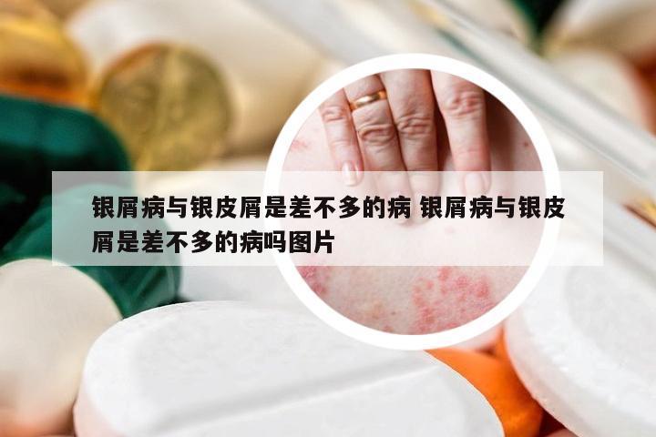 银屑病与银皮屑是差不多的病 银屑病与银皮屑是差不多的病吗图片