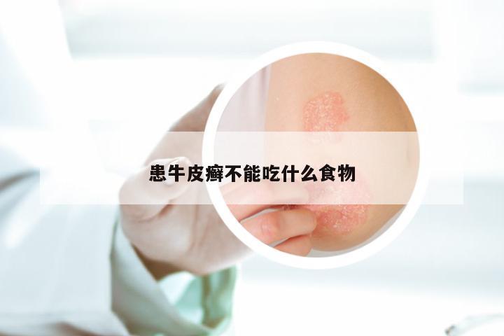 患牛皮癣不能吃什么食物