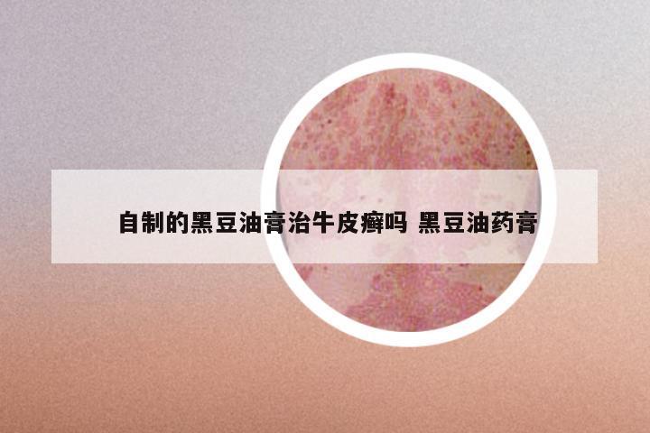 自制的黑豆油膏治牛皮癣吗 黑豆油药膏