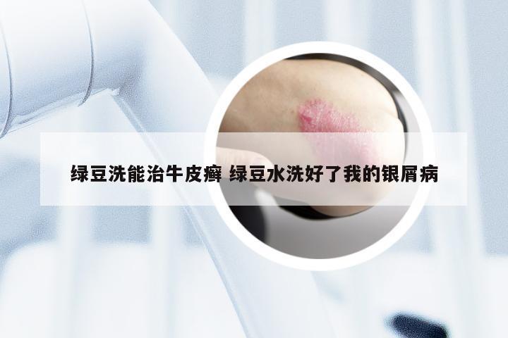 绿豆洗能治牛皮癣 绿豆水洗好了我的银屑病