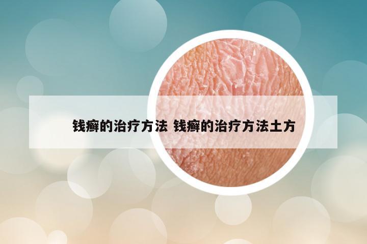 钱癣的治疗方法 钱癣的治疗方法土方