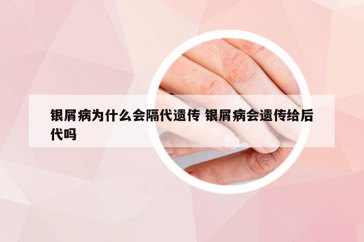 银屑病为什么会隔代遗传 银屑病会遗传给后代吗