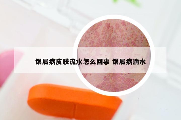 银屑病皮肤流水怎么回事 银屑病淌水