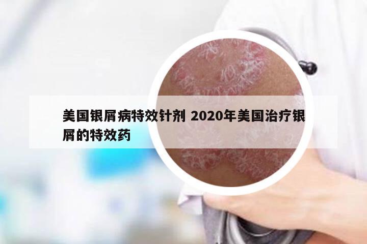 美国银屑病特效针剂 2020年美国治疗银屑的特效药