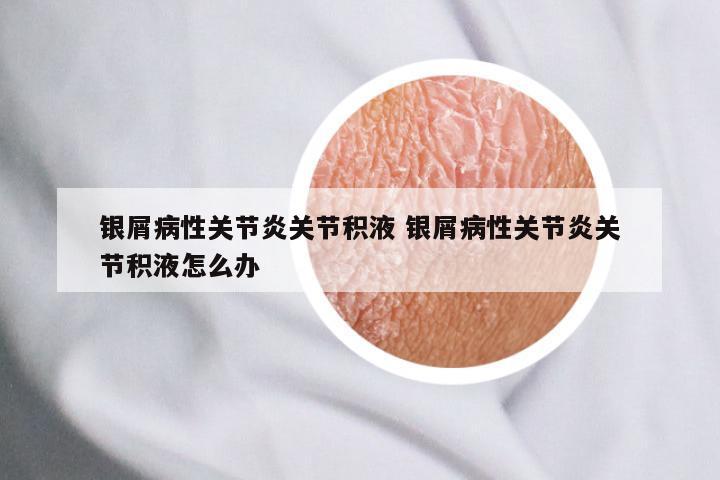 银屑病性关节炎关节积液 银屑病性关节炎关节积液怎么办
