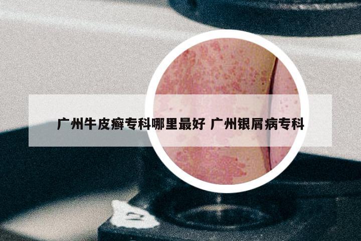 广州牛皮癣专科哪里最好 广州银屑病专科