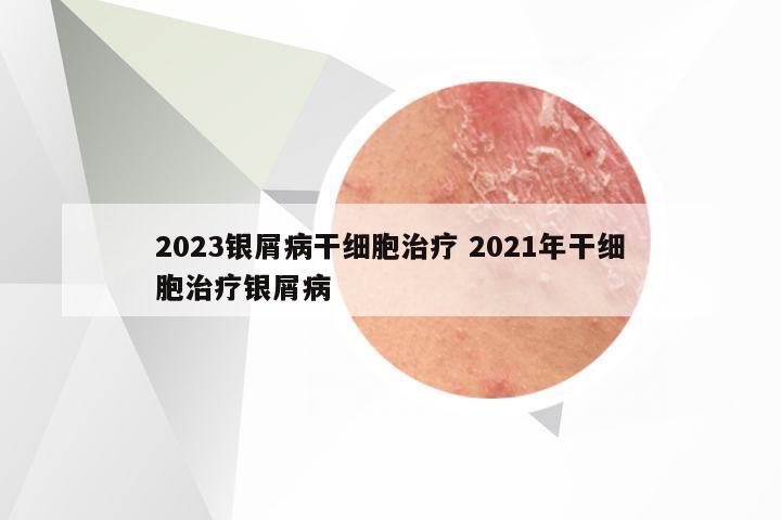 2023银屑病干细胞治疗 2021年干细胞治疗银屑病