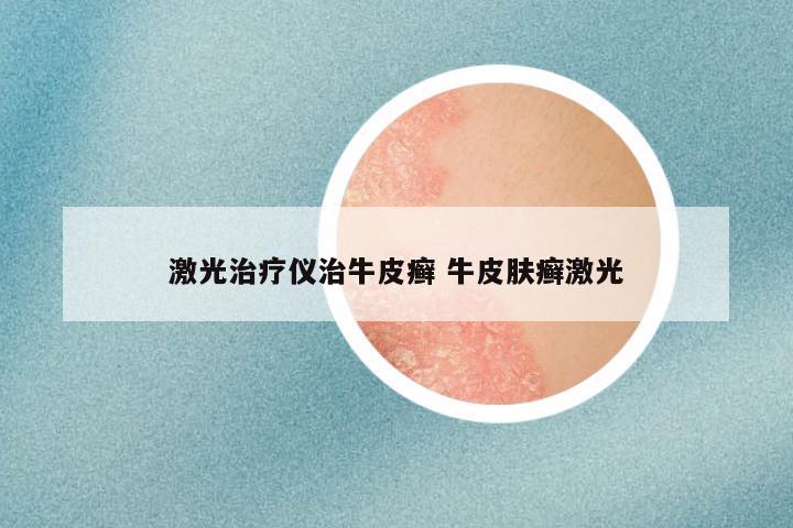 激光治疗仪治牛皮癣 牛皮肤癣激光