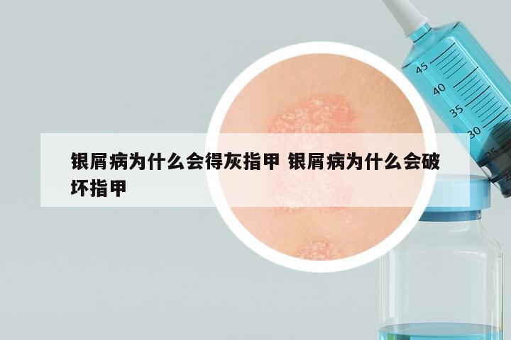 银屑病为什么会得灰指甲 银屑病为什么会破坏指甲