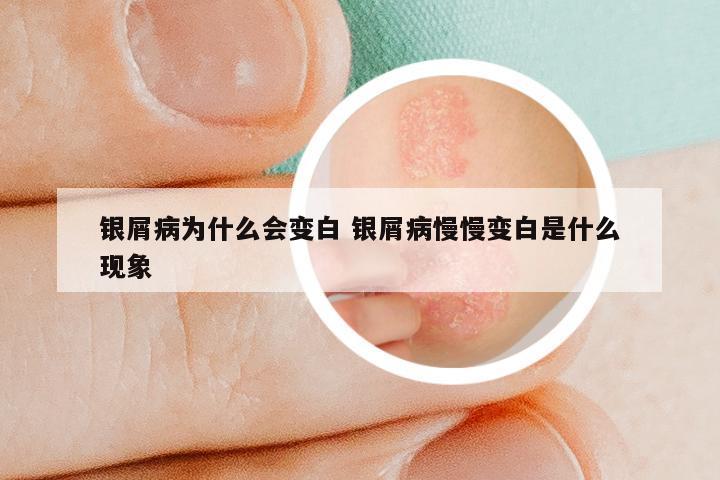 银屑病为什么会变白 银屑病慢慢变白是什么现象