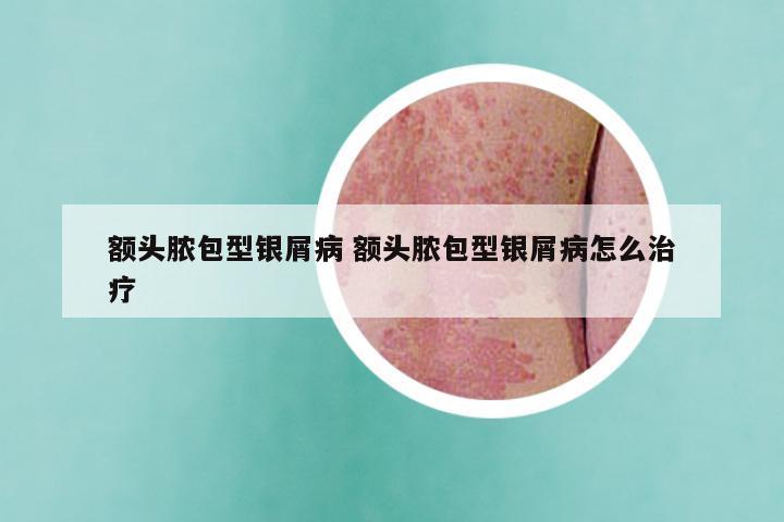 额头脓包型银屑病 额头脓包型银屑病怎么治疗